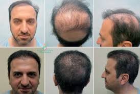 If you are worried about hair loss, or consider baldness a hindrance, then you are ready to take the next step. Hair Transplants In Bangkok Hair Restoration In Thailand Cost Reviews Page 2 Aesthetic Surgery Center Of Thailand