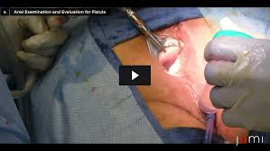 Image result for Perianal Abscess