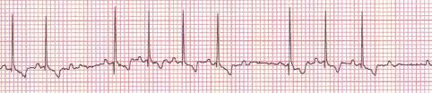 A premature ventricular contraction (pvc), also known as a premature ventricular complex, ventricular premature contraction (or complex causes. Reading Ecgs In Veterinary Patients An Introduction Dvm 360