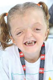 thankful for crouzon syndrome