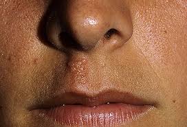Touching a cold sore also increases your risk of spreading the virus to other people. Cold Sores Pictures Of What They Look Like