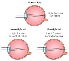 Image result for Refractive Error