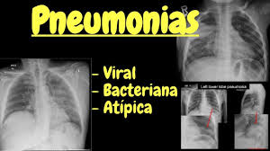 • preceding sensibilisation to microbial agent. Pneumonia Pediatriavirtual Com