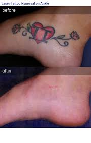 This sub is intended to discuss laser tattoo removal. My Skin Care Doctor Tattoo Removal