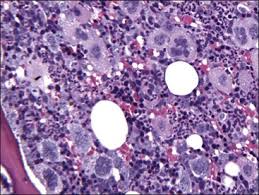 It can be acute or chronic with the acute form being more malignant. Disorders Of Bone Marrow Veterian Key