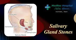 Image result for Sialolithiasis