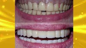 Dentures perform this task just as effectively as natural teeth. Upgrading Your Loose Fitting Dentures To Cemented Permanent Teeth Youtube