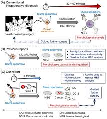 A positive lumpectomy margin means cancer cells come to the edge of the removed tissue. Scientists Develop System To Rapidly And Accurately Detect Tumor Margins During Breast Cancer Surgery