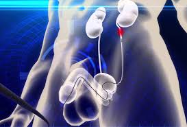 Kidney Stone Surgery Method Healthdept