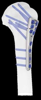 PHF & PGR Plate Proximal humerus