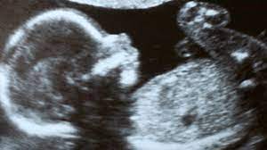 Bebeğin cinsiyetinin belli olabilmesi için öncelikle cinsiyet organlarının gelişmiş olması gerekir. Bebegin Cinsiyeti Ne Zaman Belli Olur Cinsiyet Tayini Neden Gerekli Saglik Haberleri Ntv