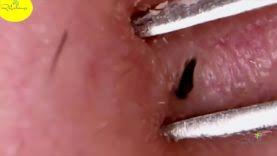 Several social media accounts and youtube channels are now dedicated solely to ingrown hair extraction. Ingrown Hair Removal Blackhead Pimple Popping Most Satisfying Videos In The World 9 Hd 2018 Pimple Popping Videos