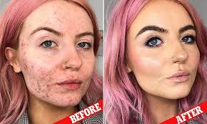 Women Are Praising This Foundation For Completely Covering Their Acne Acne Makeup Acne Skin Acne