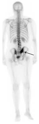In addition to confirming that cancer has spread to the bones, imaging studies can help identify the type of bone metastases involved. Does Colon Cancer Ever Metastasize To Bone First A Temporal Analysis Of Colorectal Cancer Progression Bmc Cancer Full Text