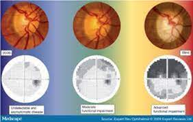 If not diagnosed early enough, glaucoma can lead. The Optic Nerve In Glaucoma Intechopen