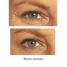 Botox Yan Etkilerine Dikkat Botox Uygulama Sirasinda Yanlislikla Goz Kapagi Kasina Uygulanirsa Gecici Kapak Dusuklugune Yol Acabilir Goz C Bilgi Gozler Yaya