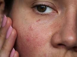 Image result for red rash face