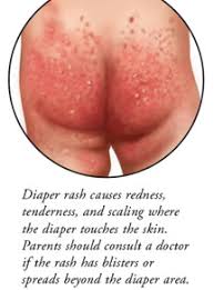Image result for diaper dermatitis