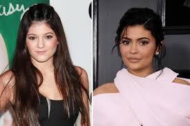 This is said to be caused due to botox injections given into her forehead and around the eye area. Deska Svaty Labyrint Kylie Kendall Before And After Vzhuru Nohama Pomlcka Ukazatel