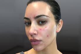 Lupus occurs when antibodies attack the healthy cells in the body. Ù…Ø§Ø°Ø§ ØªØ¹Ø±Ù Ø¹Ù† Ù…Ø±Ø¶ Ø§Ù„Ø°Ø¦Ø¨Ø© Ø§Ù„Ø­Ù…Ø±Ø§Ø¡ Ø£Ø®Ø¨Ø§Ø± ØµØ­ÙŠÙØ© Ø§Ù„Ø±Ø¤ÙŠØ©