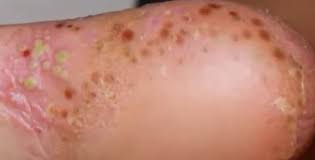 Image result for Pustular Psoriasis