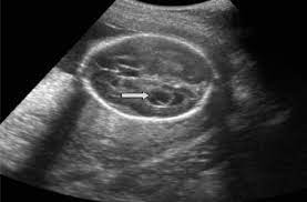 Ultrasonographic Soft Markers Of Aneuploidy In Second Trimester Fetuses Sciencedirect