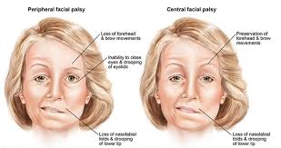 A minor stroke captured