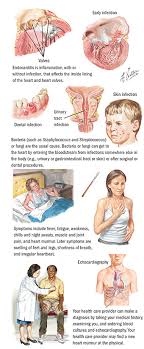 Inflammatio) is part of the complex biological response of body tissues to harmful stimuli, such as pathogens, damaged cells, or irritants. Endocarditis Cardiovascular Care Spectrum Health
