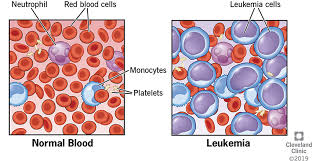 Bone marrow is found inside the central part of bones and produces white blood cells, red blood cells and platelets. Leukemia Symptoms Types Causes Treatments