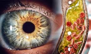 Eye Symptoms A White Ring Around The Iris Could Indicate High Cholesterol Express Co Uk