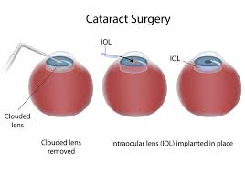 5 Ways To Prevent And Treat Cataracts In Dogs Cataract Surgery Eye Surgery Cataract