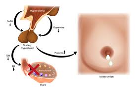 Image result for Hyperprolactinemia