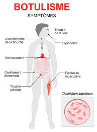 Er zijn zeven verschillende typen botuline waaronder drie die gevaarlijk zijn voor de mens. Botulisme Causes Symptomes Traitements Sante Sur Le Net