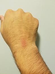 Jun 28, 2010 · a: Icy Hot Burn Album On Imgur