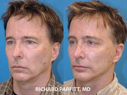 Learn more in this howstuffworks article. Male Plastic Surgery Before And After Photos