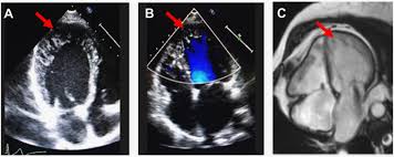 Image result for Left Ventricular Noncompaction