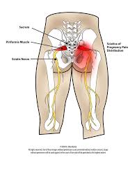 Pin On El Paso Sciatica Institute