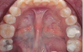 Copyright © 2017 asociación española de micología. Paciente Endodontico Con Mucormicosis Rinocerebral Reporte De Un Caso Sciencedirect