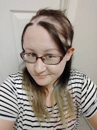 If you or someone you know is suffering with trichotillomania, the experts at suisse natural hair salon can help. 23 Pictures That Show The Reality Of Living With A Body Focused Repetitive Behavior