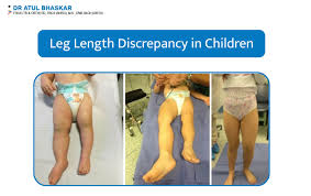 Image result for Pediatric Leg Disorder