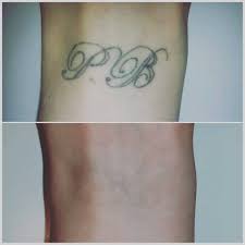 Have any of you had laser tattoo removal done? Laser Tattoo Removal Cheltenham Forever Clinic Cheltenham