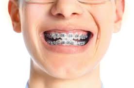 Pin On Braces