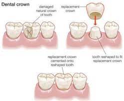 Criteria For Dental Fillings And Crowns Dental Crowns Dental Dental Fillings