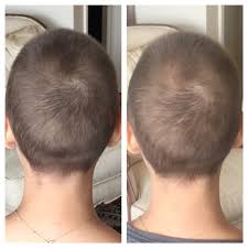 And while whatnexter's were glad, they were also a little bit surprised. 5 Under 40 Foundation New York City Growing Your Hair Back