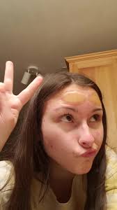 Effective Acne Treatment with Hydrocolloid Bandages