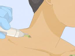 Hautanhangsel Am Hals Entfernen Wikihow