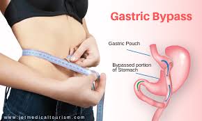 ما هي الشروط الواجب تواجدها اثناء تكميم المعدة In 2020 Gastric Bypass Gastric Bypass Surgery Weight Reduction