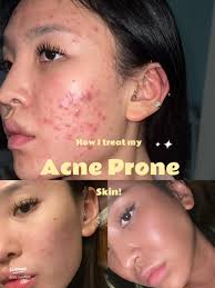 Overcoming Acne: My Journey & Top Products That Helped
