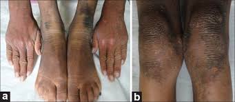 Image result for Diffuse Hyperpigmentation