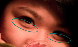 Other times we get puffy eyes after sleeping. Periorbital Puffiness Wikipedia